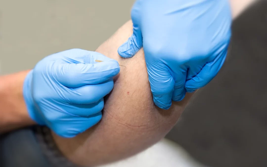 Achieve Dry Needling Results at Home