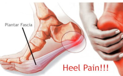 Kiss Plantar Fasciitis Goodbye