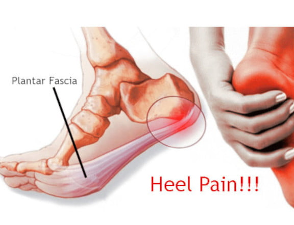 Kiss Plantar Fasciitis Goodbye